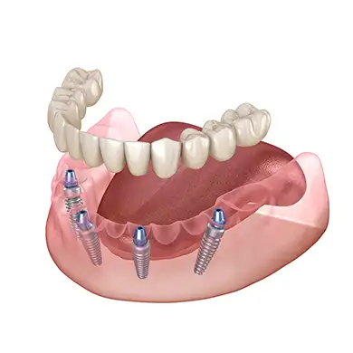 All-on-Four-Implantat