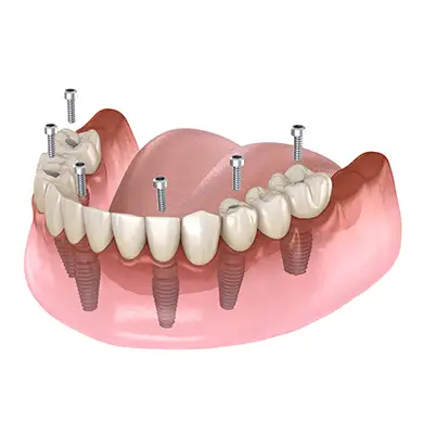All-on-Six-Implantat